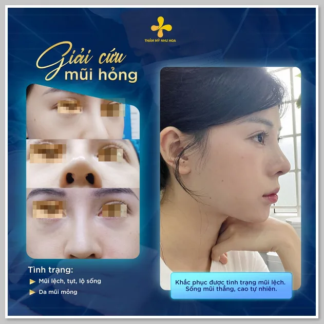 Một số khách hàng sửa mũi hỏng thành công thực hiện bởi Tiến sĩ Thẩm mỹ Tống Hải 