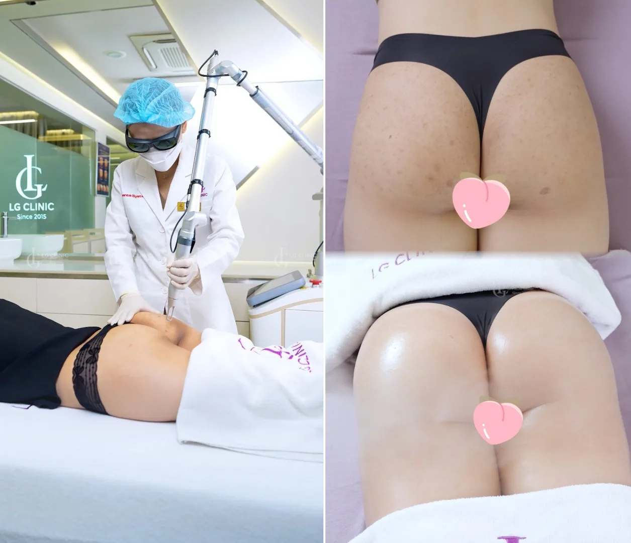 địa chỉ trị thâm mông sg